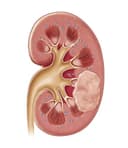 Kidney Cancer Treatment